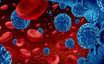 myeloma disease